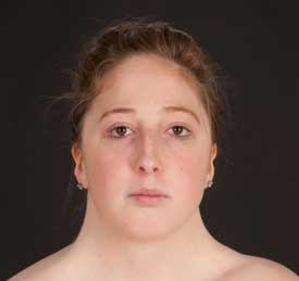 Girl showing Facial features of Turner syndrome